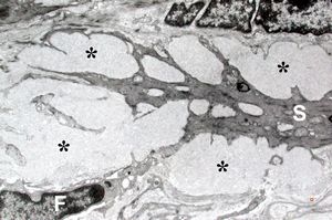 M,60y. | jejunum - amyloidosis M,60y. | jejunum - amyloidosis